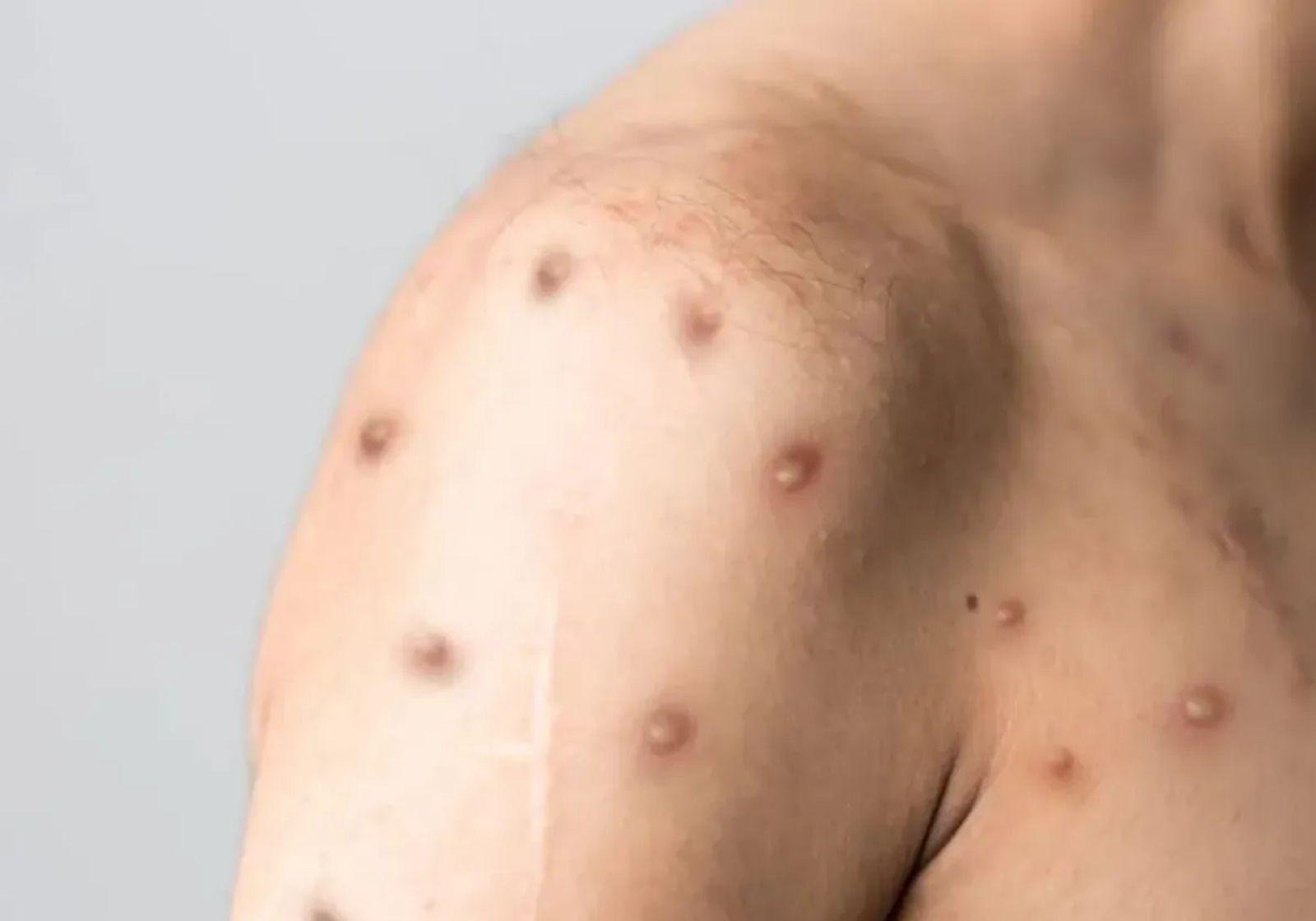 Mpox em Formiga: primeiro caso de 2026 no Centro-Oeste de MG | G1