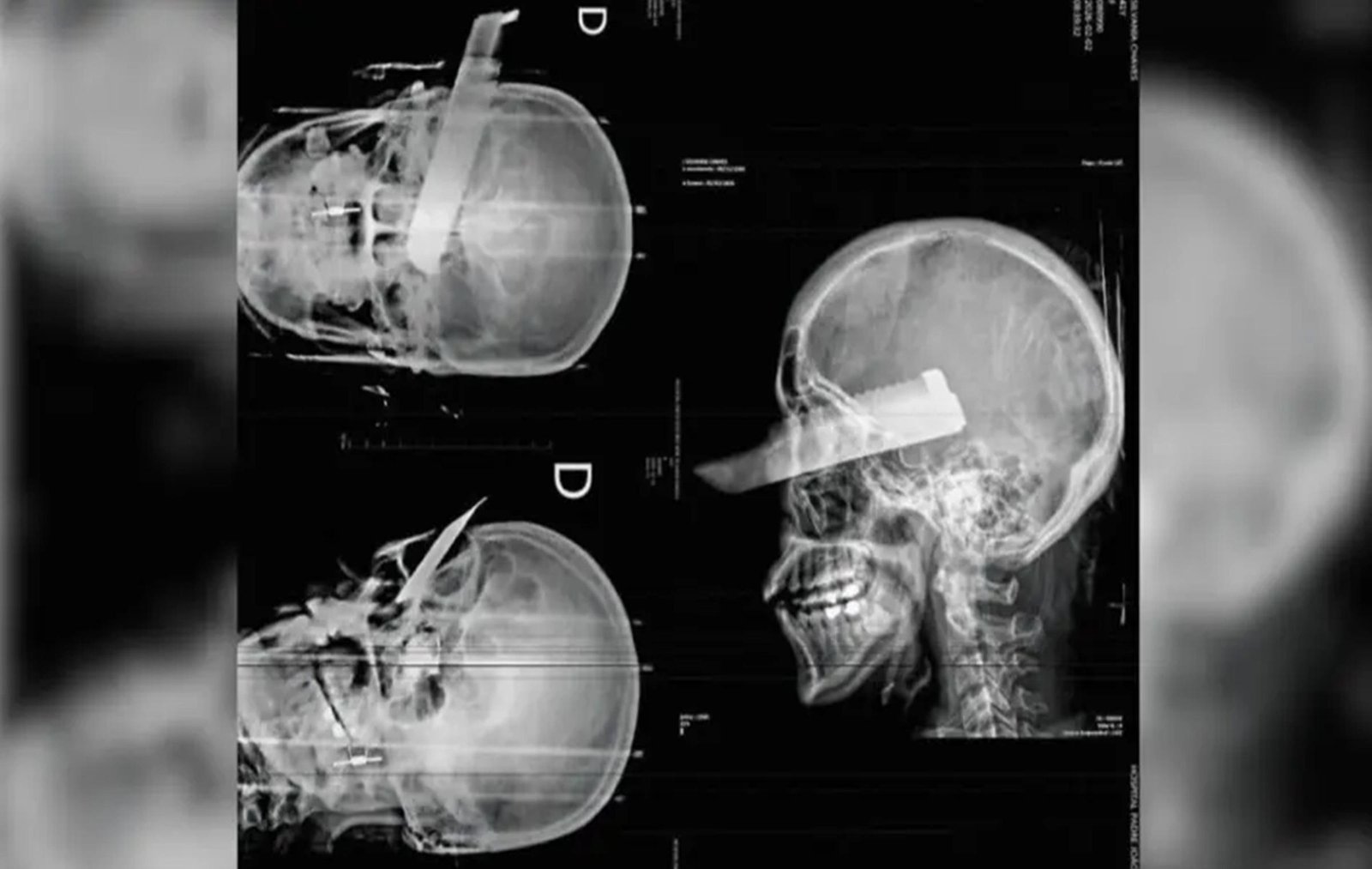 Mulher tem faca cravada no olho em tentativa de feminicídio em SC