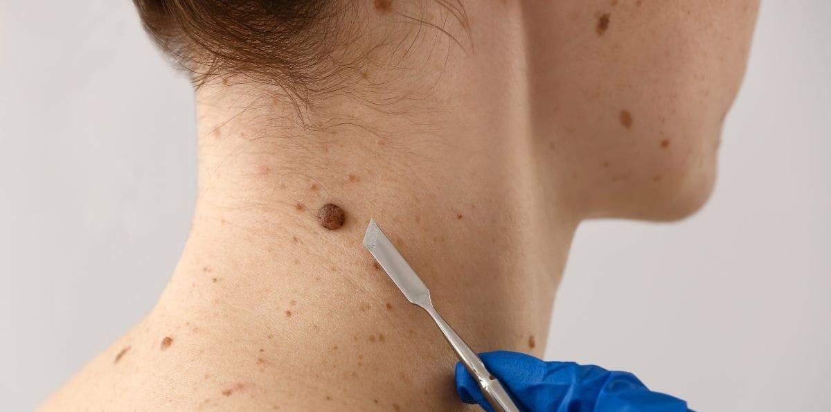 40% dos casos de câncer no mundo poderiam ser evitados, diz OMS