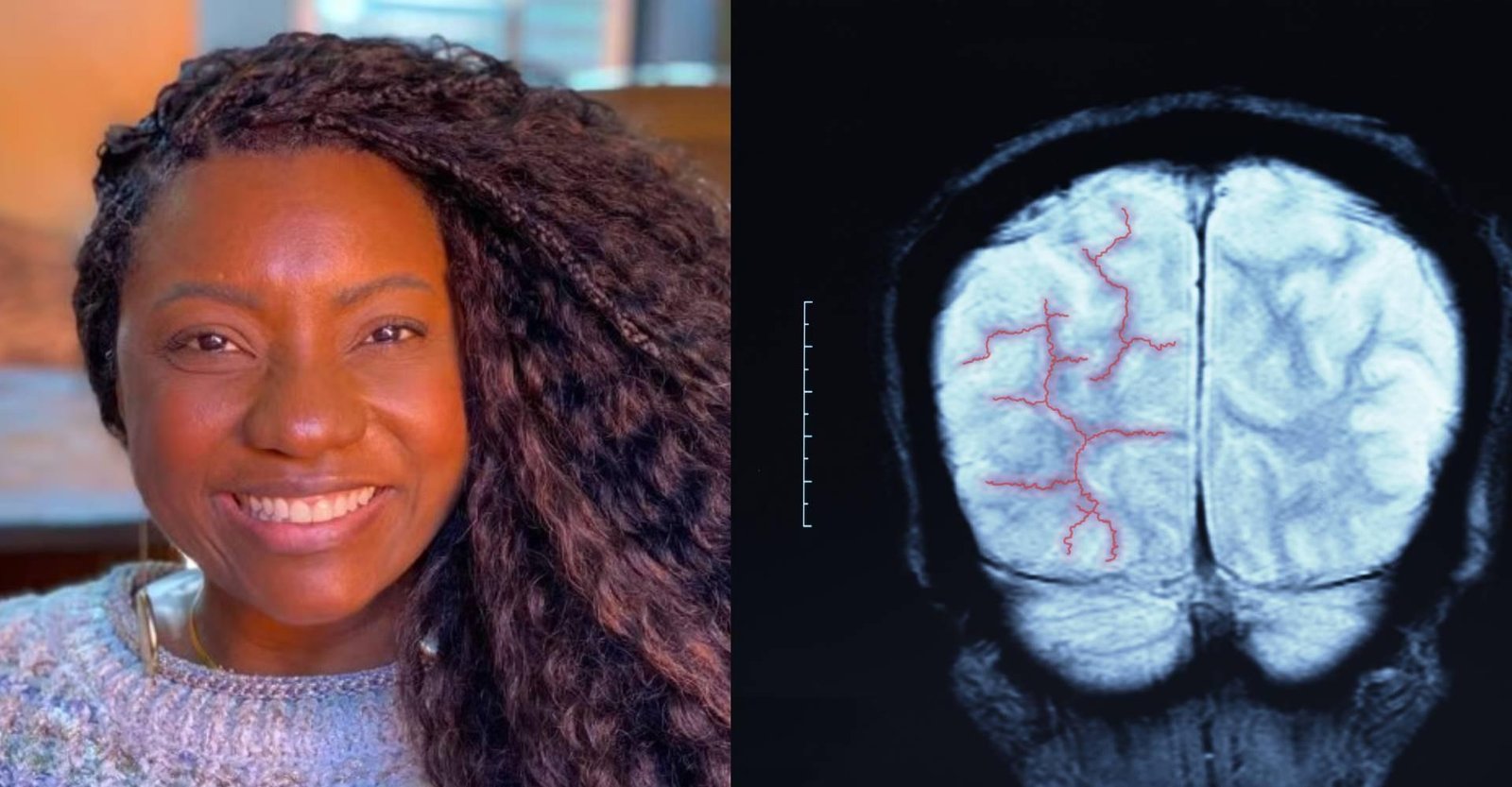 Aneurisma cerebral; entenda o que causou o coma de Adriana Araújo | G1