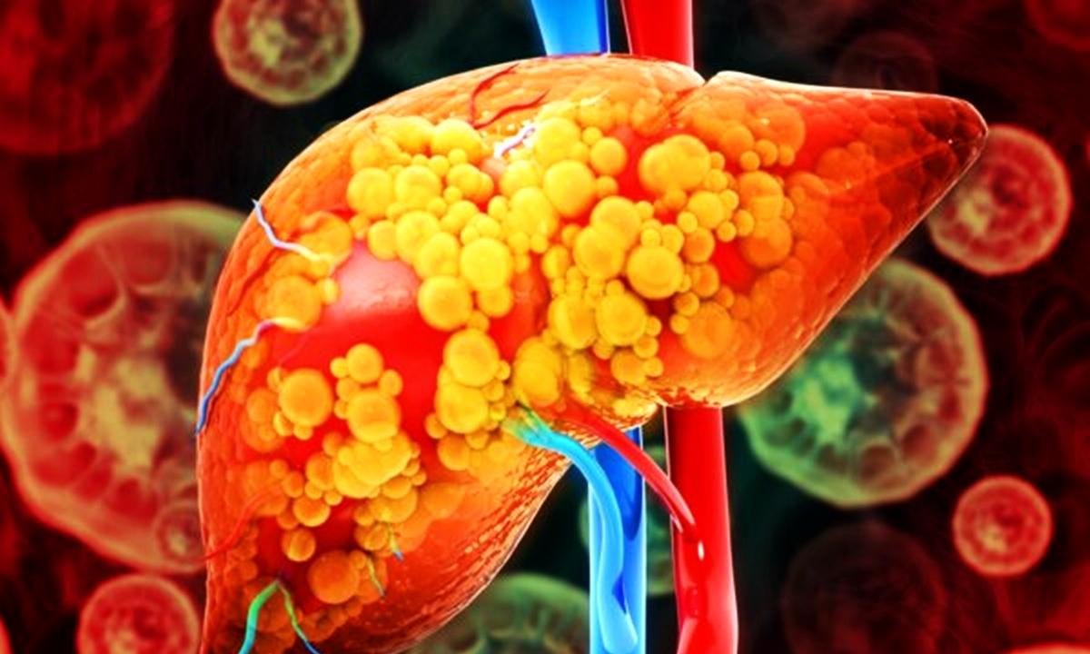 Hepatologista responde: toda gordura no fígado evolui para cirrose?