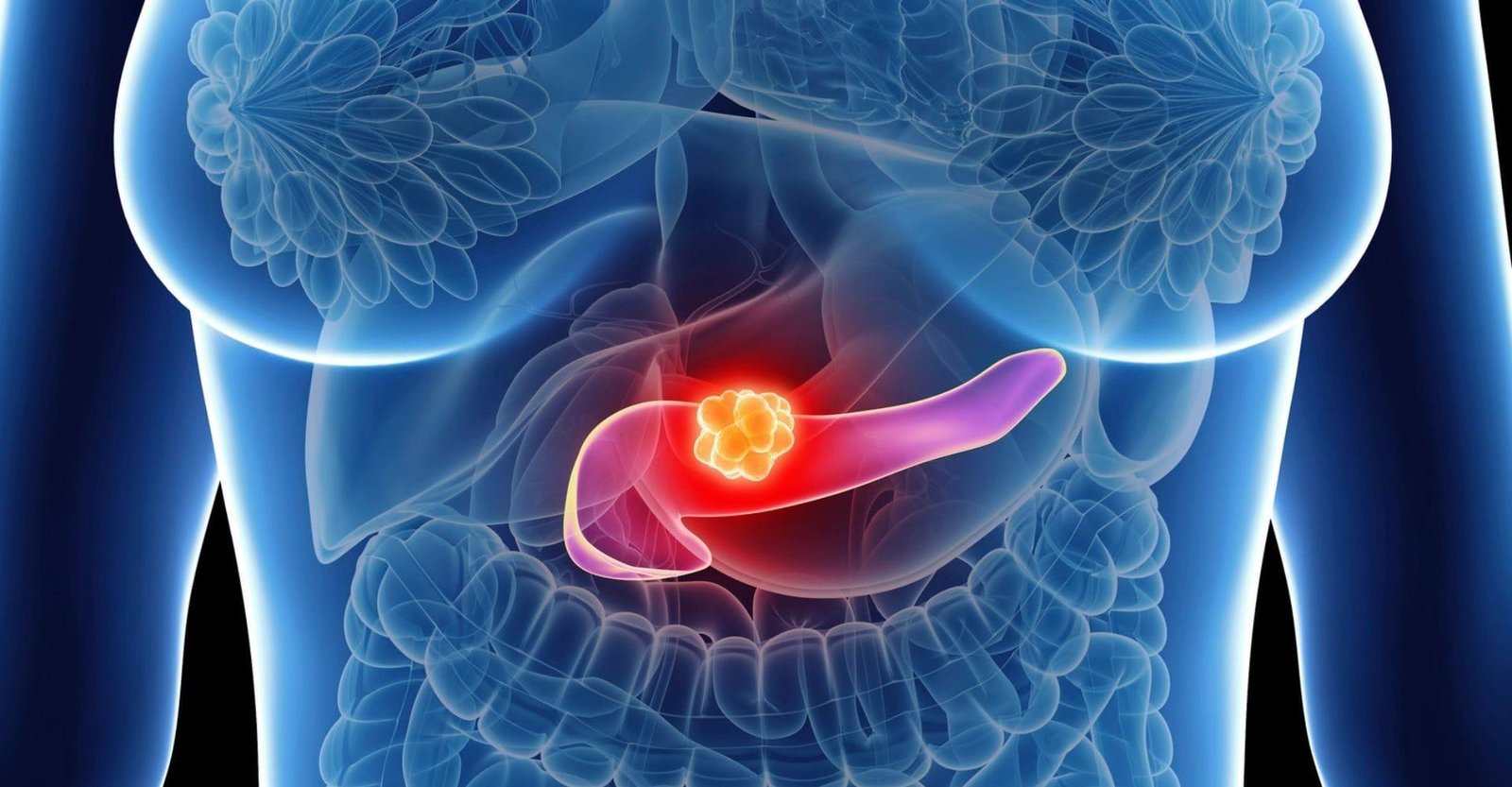 Estudo espanhol apresenta tratamento promissor contra câncer de pâncreas