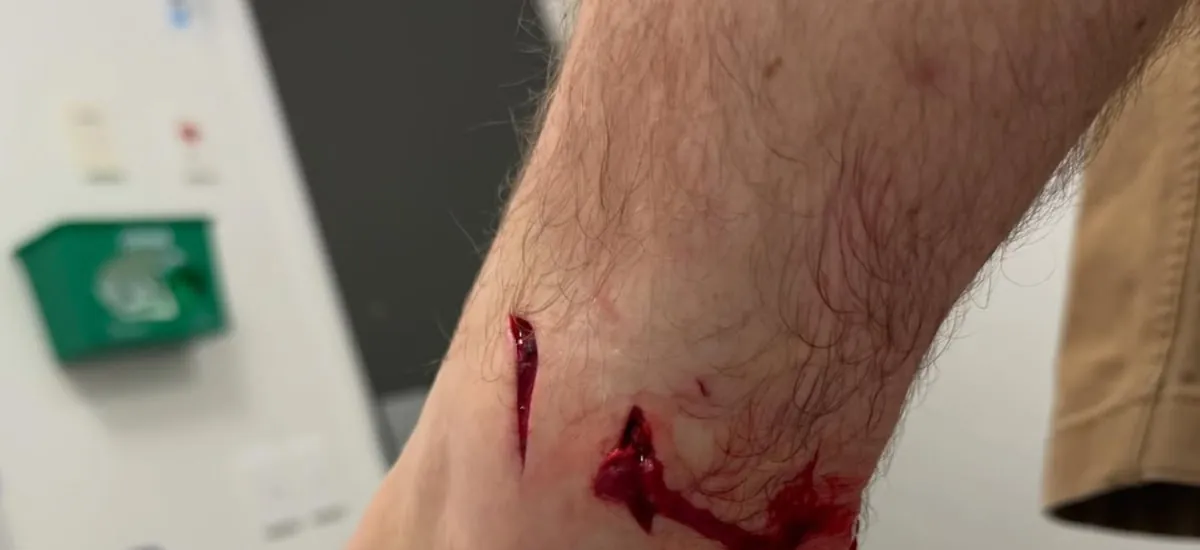 Fotógrafo atacado por animal marinho no Mundial de Surfe passará por cirurgia; imagens fortes