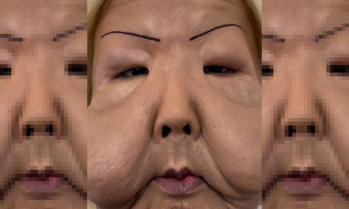 Juju do Pix mostra rosto 3 meses após retirar óleo mineral e choca web