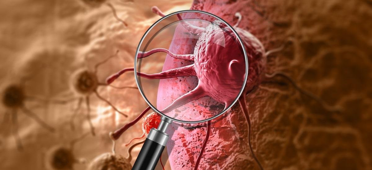 Opinião | O câncer está matando mais e menos - ao mesmo tempo. Como isso é possível?