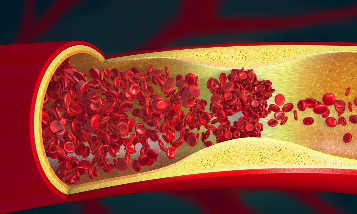Médico vascular diz se dá para reverter quadro de gordura nas artérias