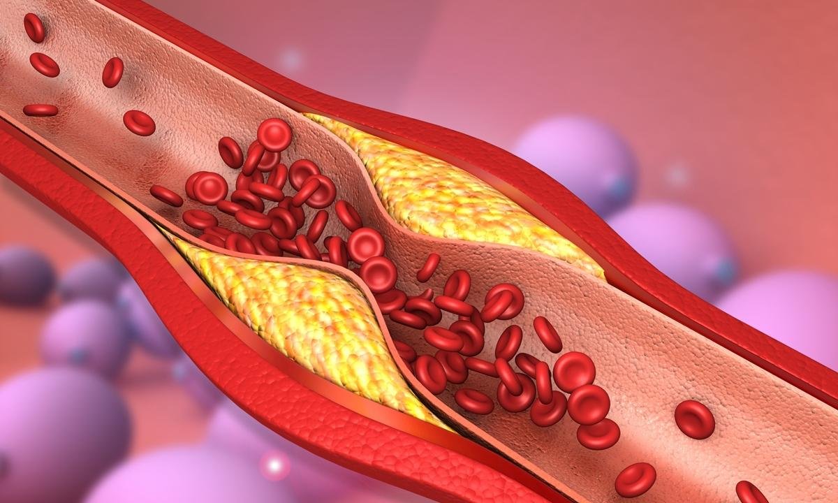 Médico cita sinais do corpo quando artérias do coração estão entupidas