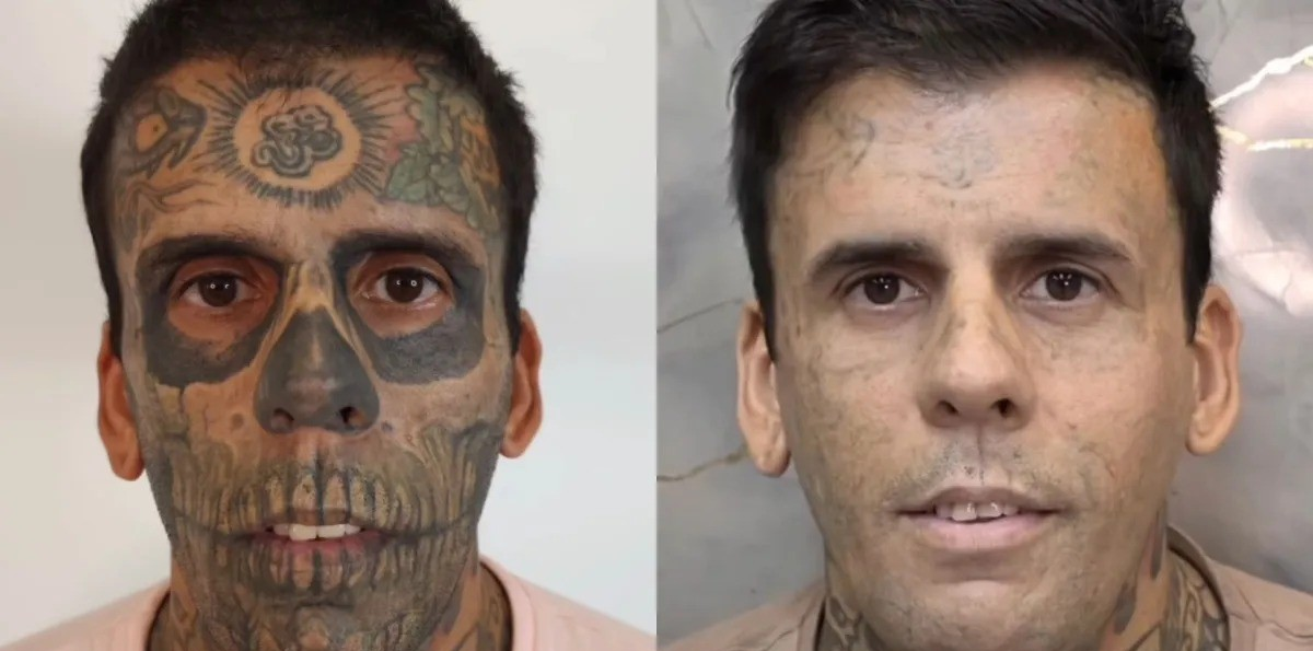 Homem 'mais tatuado do Brasil' passa por nova sessão de remoção e diz se preparar para vida missionária
