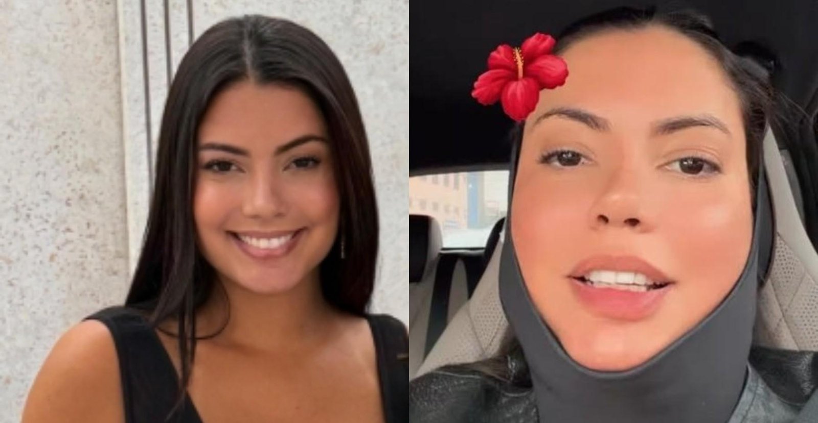 Ex-BBB Fernanda Bande faz procedimento para papada; veja outras opções para o contorno do rosto