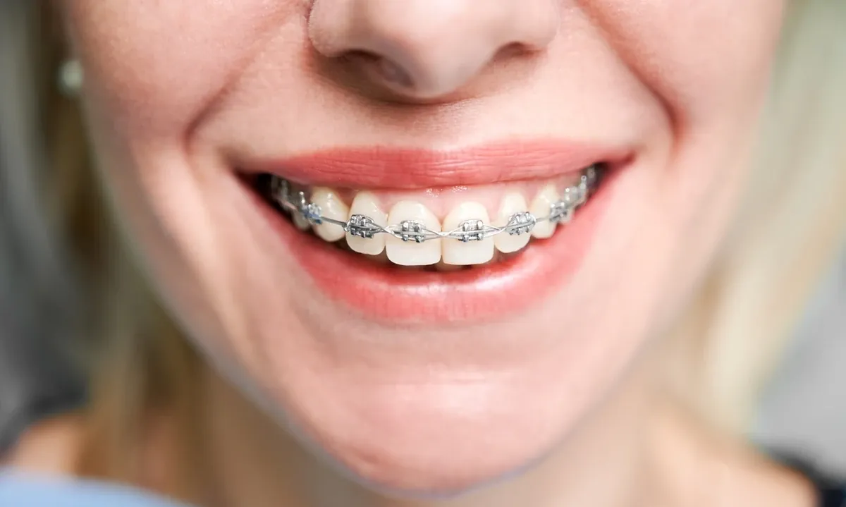 Por que os dentes voltam a entortar após o uso de aparelho ortodôntico