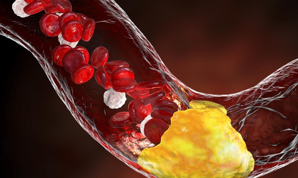 Médico vascular diz se dor nas pernas pode indicar artérias entupidas