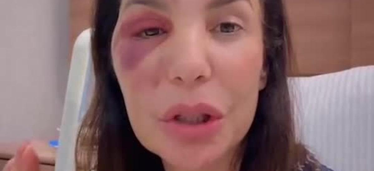 Ivete Sangalo aparece em vídeo após cirurgia no rosto: ‘Poderia ter sido pior’; assista
