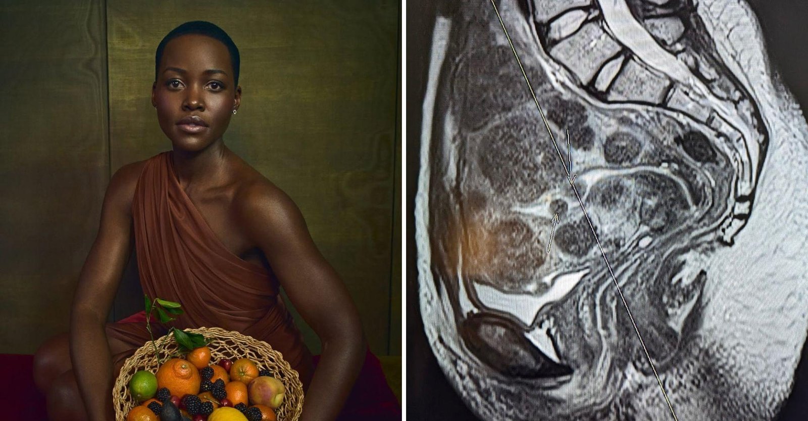 Lupita Nyong’o compartilha ressonância e fala sobre 77 miomas uterinos