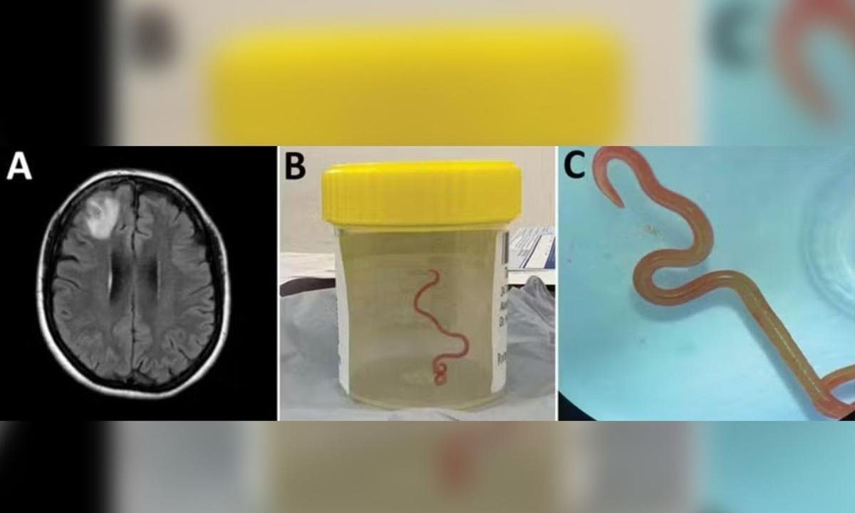Verme parasita de cobra é encontrado pela 1ª vez no cérebro de humanos