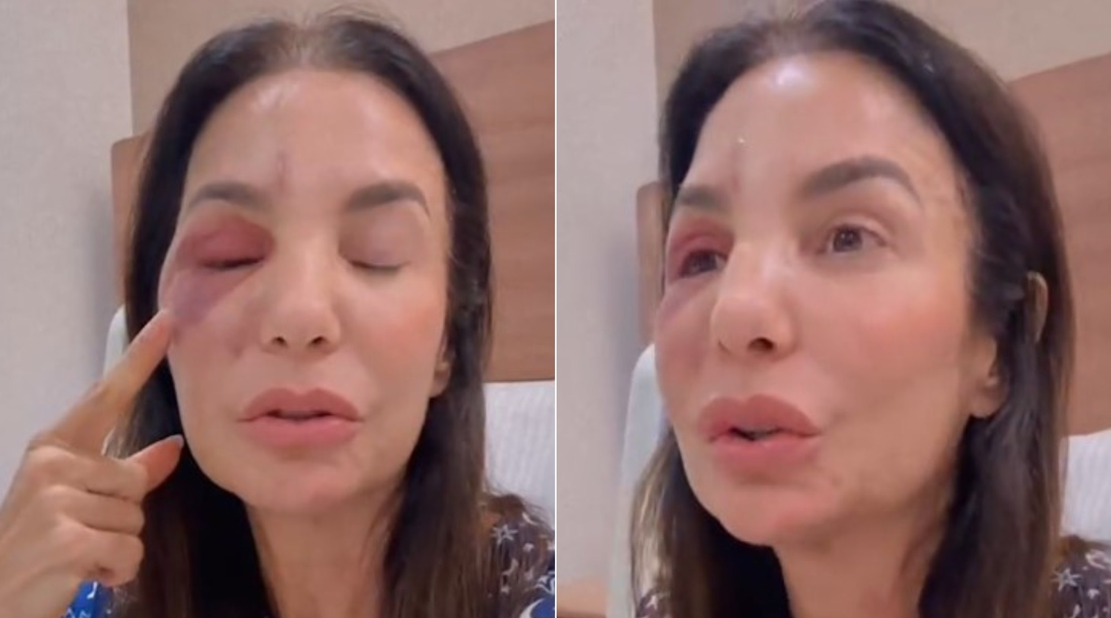 Famosos prestam apoio a Ivete Sangalo após cantora detalhar 'lesão grave' com ossos quebrados na face