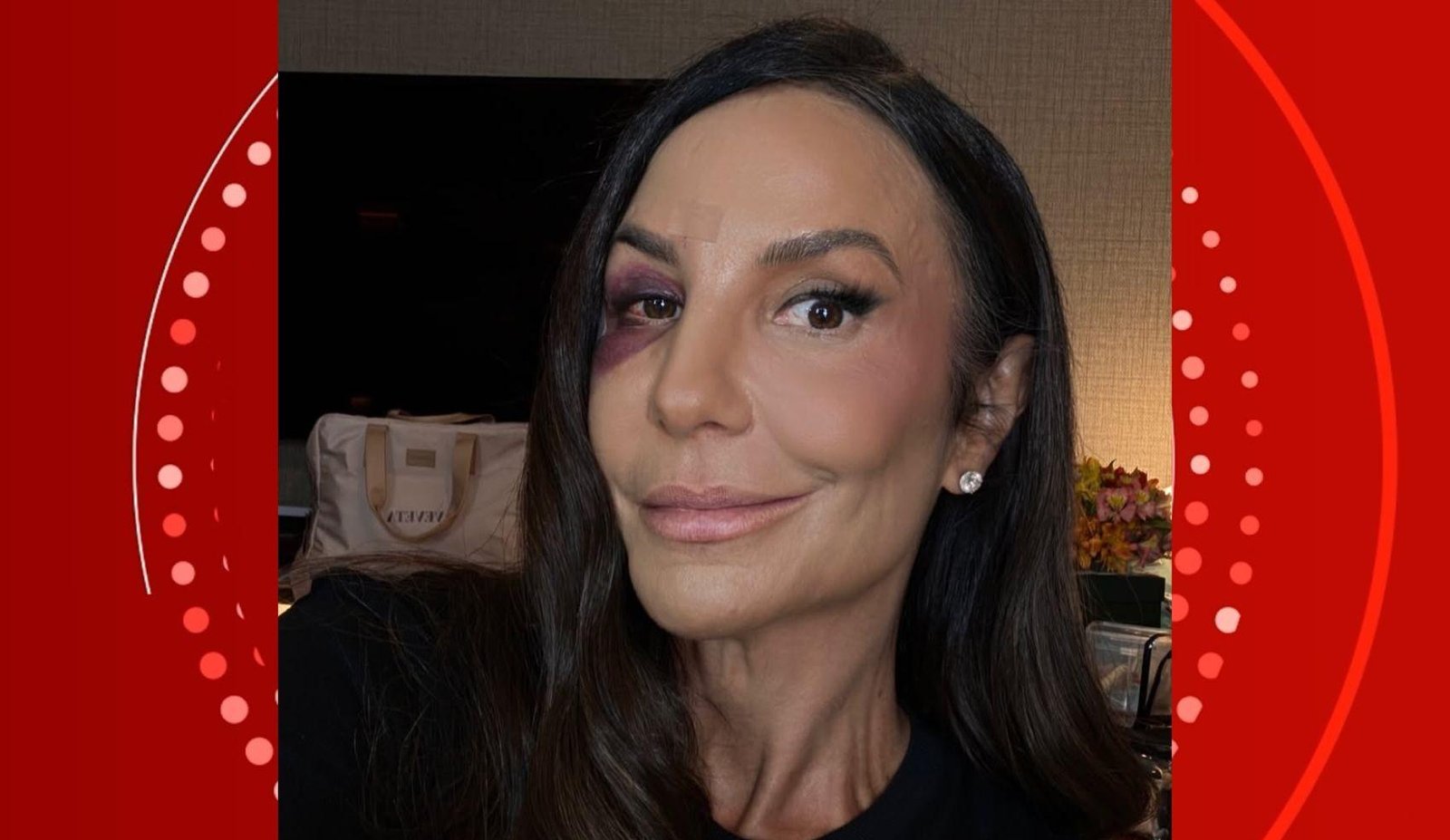 Ivete mostra rosto dois dias após queda e recebe apoio de famosos | G1