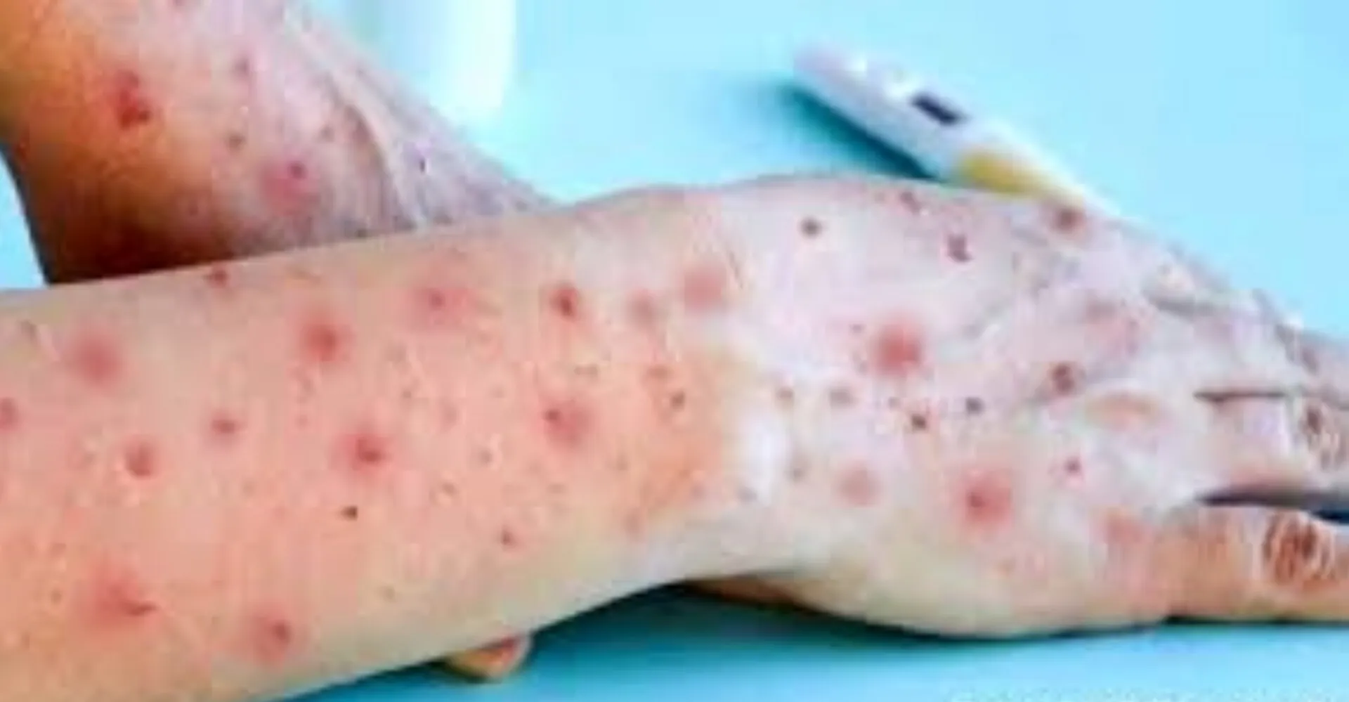 Pacientes com suspeita de mpox testam negativo para a doença em Governador Valadares | G1