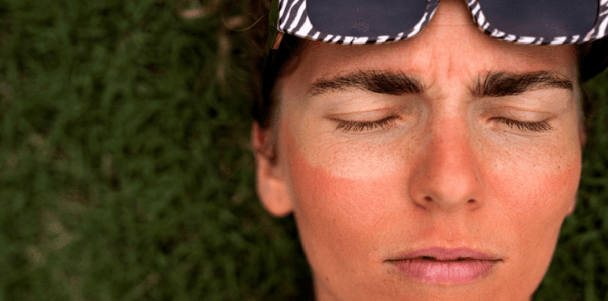 Manchas na pele após o verão: por que janeiro exige mais cuidados