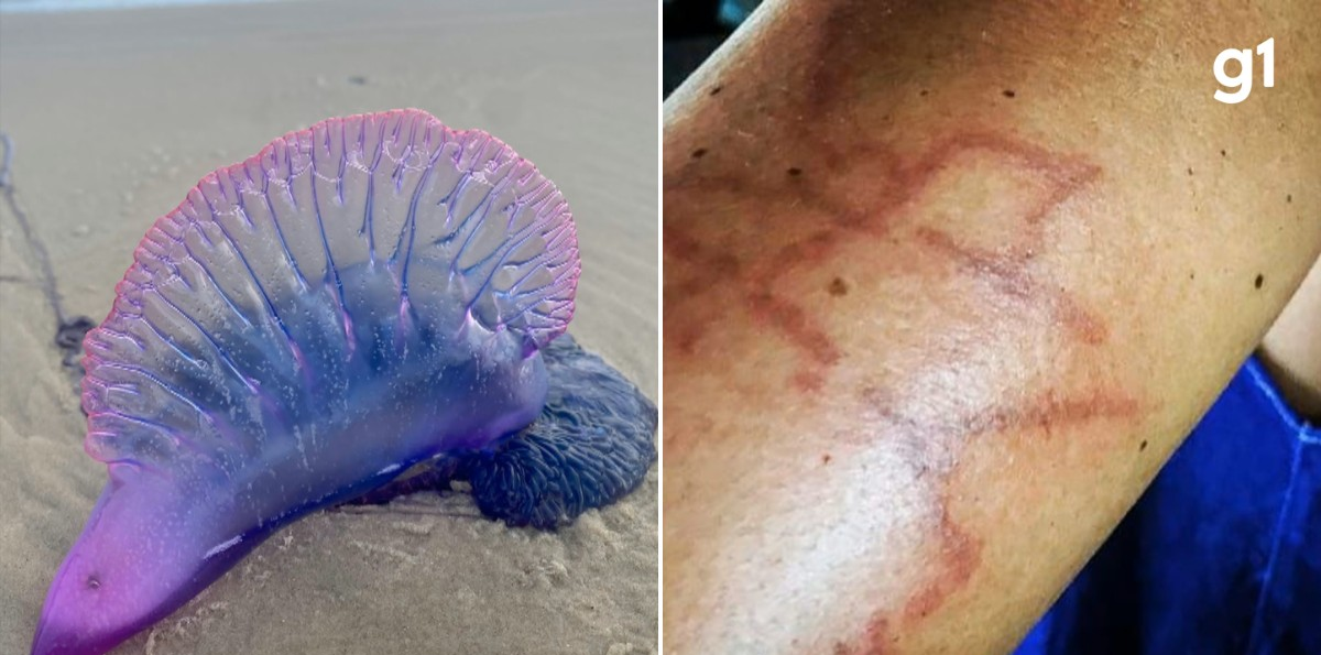 Queimaduras de caravelas-portuguesas preocupam no RS: veja o que fazer | G1